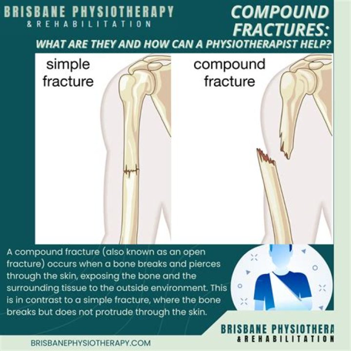 What is an open compound fracture?