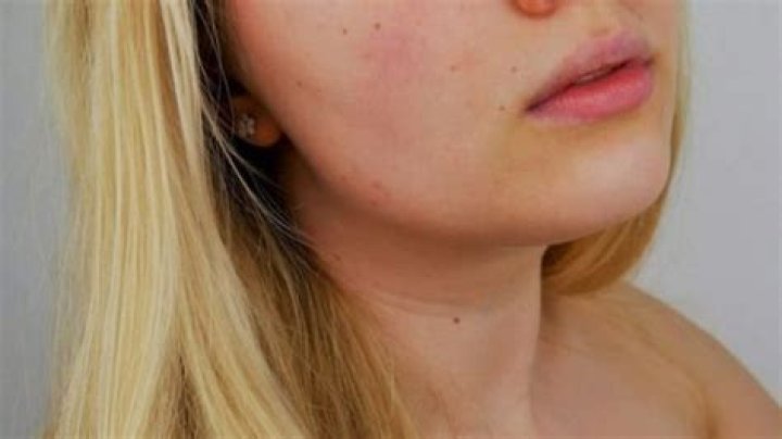 What is duac cream used for?