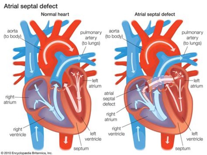 What is overriding aorta?