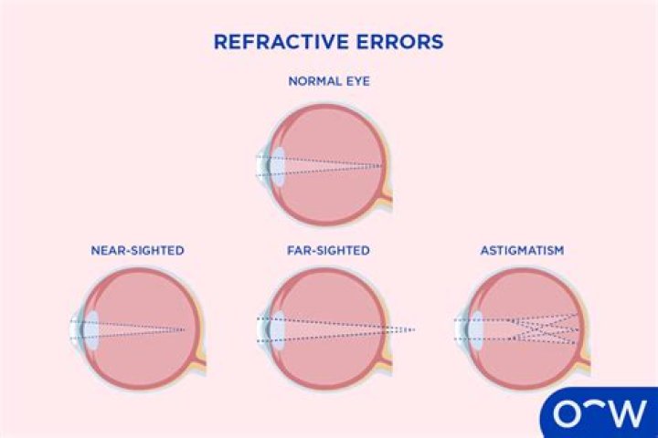 What is refraction Ophthalmology? | ContextResponse.com