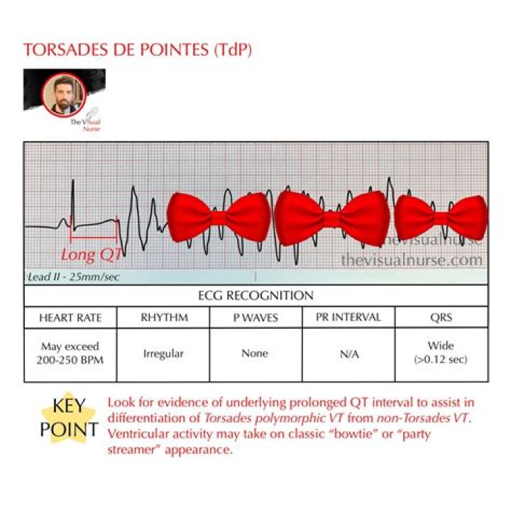 What is torsades de pointes ECG?