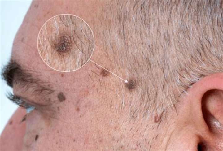 What kind of moles are dangerous?