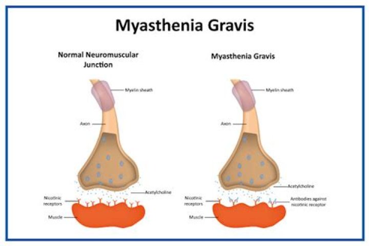 What neurotransmitter is at fault with myasthenia gravis?