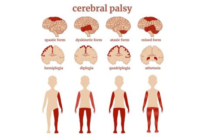 What type of cerebral palsy is most common?