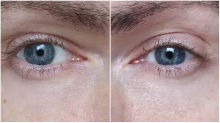 Why do I have bumpy skin under my eyes?