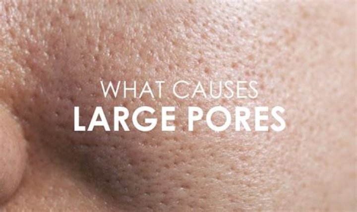 Why do I have large pores?
