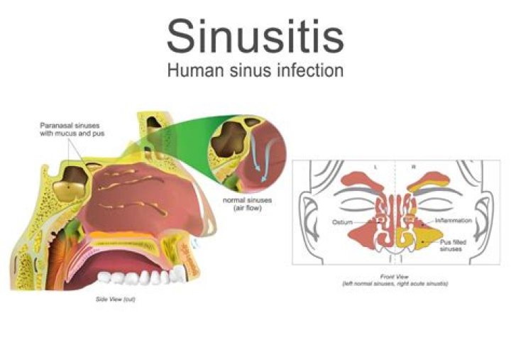 Why does sinusitis make you tired?